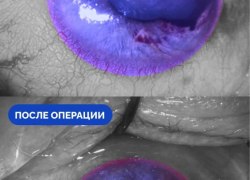 Рыбаку из Югры спасли поврежденный крючком глаз