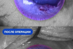 Рыбаку из Югры спасли поврежденный крючком глаз